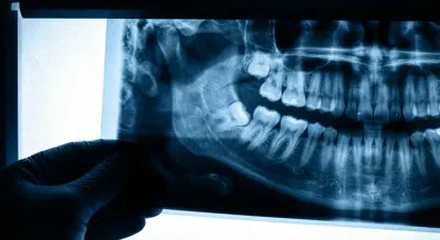 Plan rapproché d'une radiographie dentaire montrant les dents de sagesse incluses.