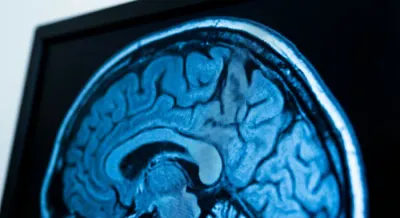 Gros plan sur un cliché IRM cérébral montrant les contrastes et les zones d'hyposignal